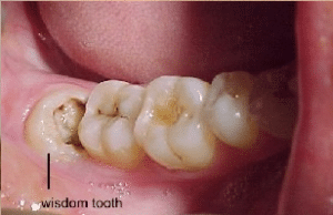 tooth extraction decatur