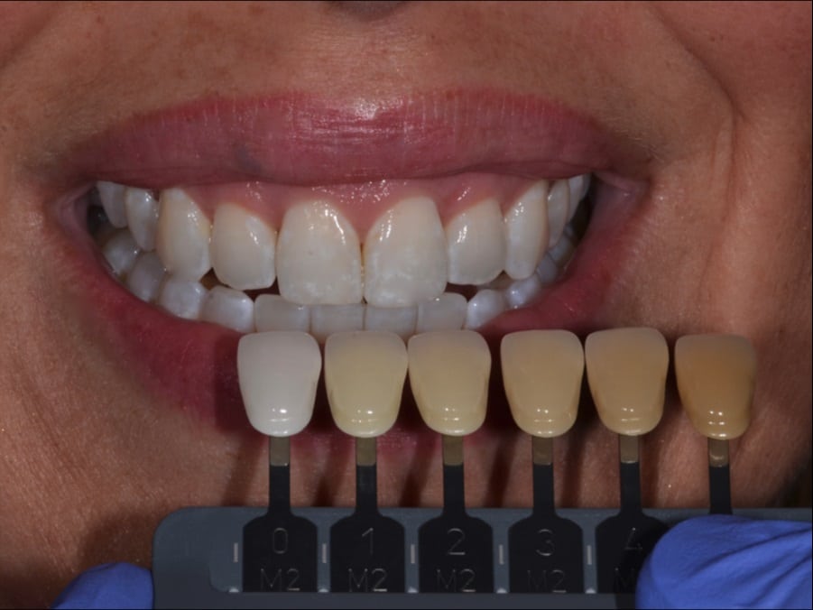 A dentist comparing dental crown shades with a shade guide to achieve a perfect match.