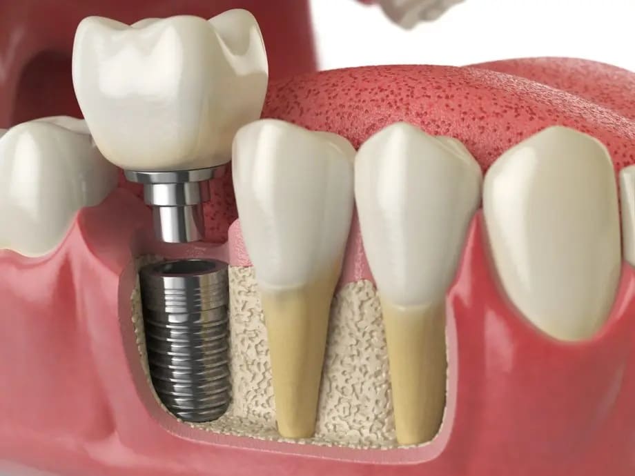 A close-up image of a dental implant procedure, showcasing a tooth-like crown being implanted into the jawbone.