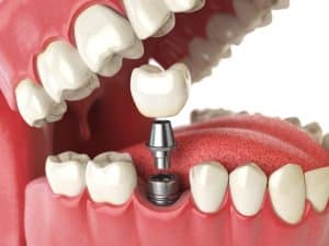 A dental implant restoration showcasing its natural appearance and functionality.