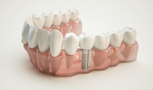 Dental implant cost considerations in Decatur, GA.