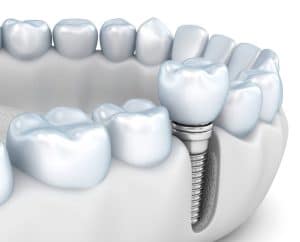 Dental implant cost considerations in Decatur, GA.