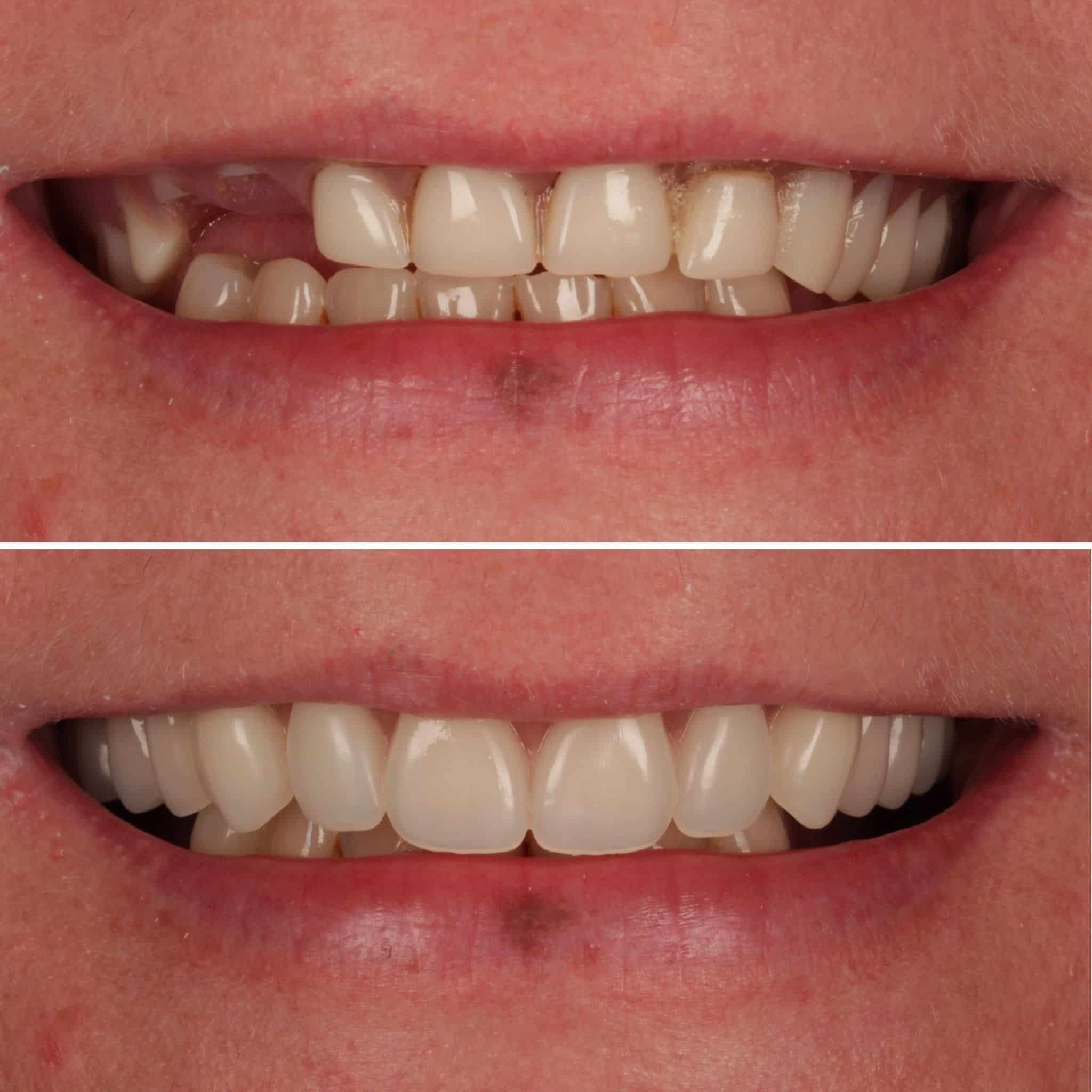 A smiling person with dentures experiencing a transformative smile in Decatur, GA.