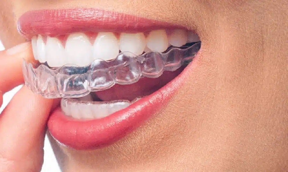 A person confidently smiling with Invisalign aligners.