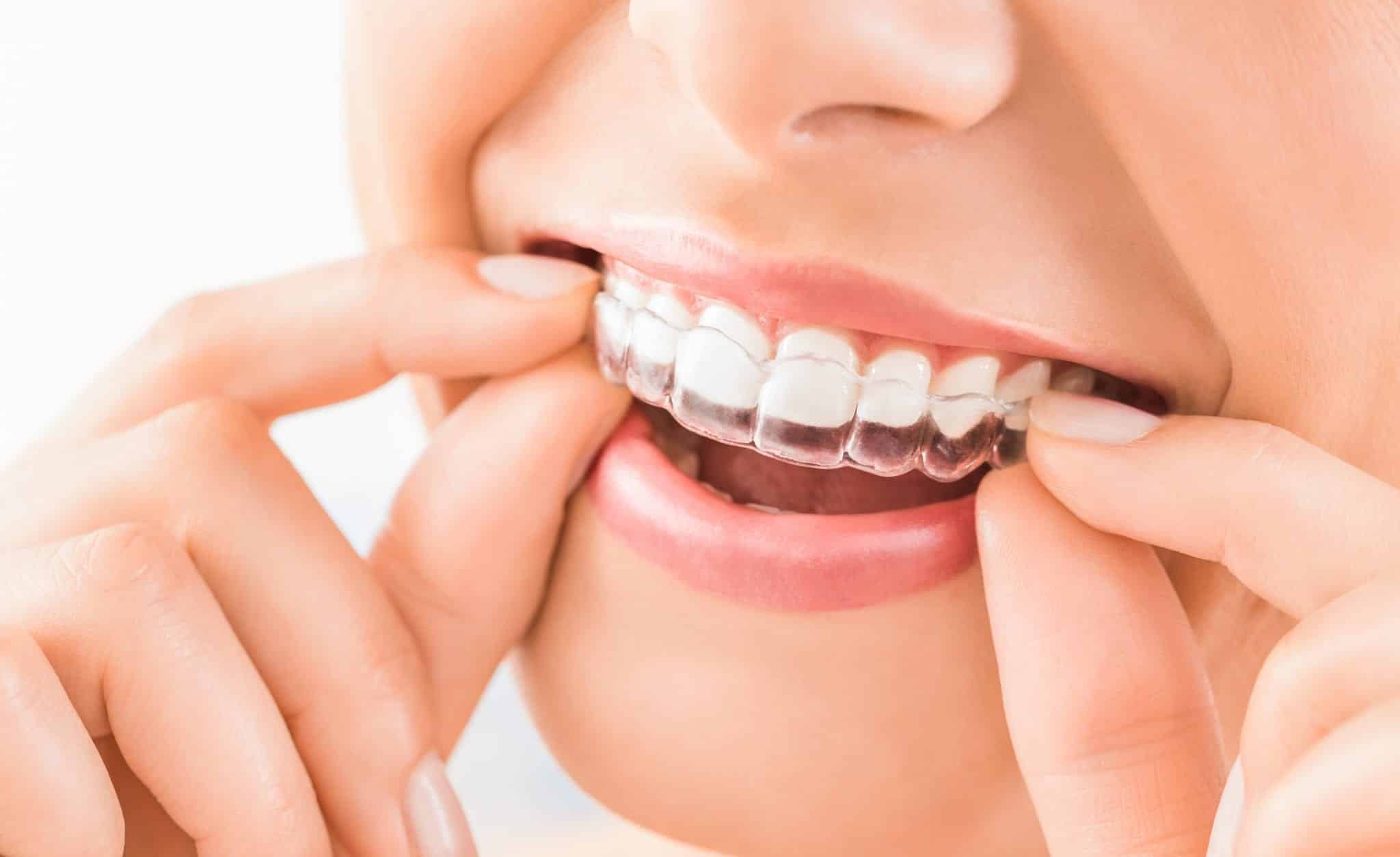 Invisalign clear aligners and helpful tips for a perfect smile