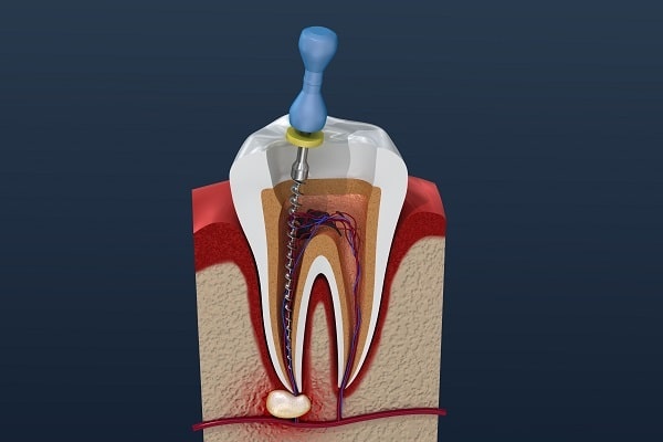 Illustration of a Root Canal Treatment