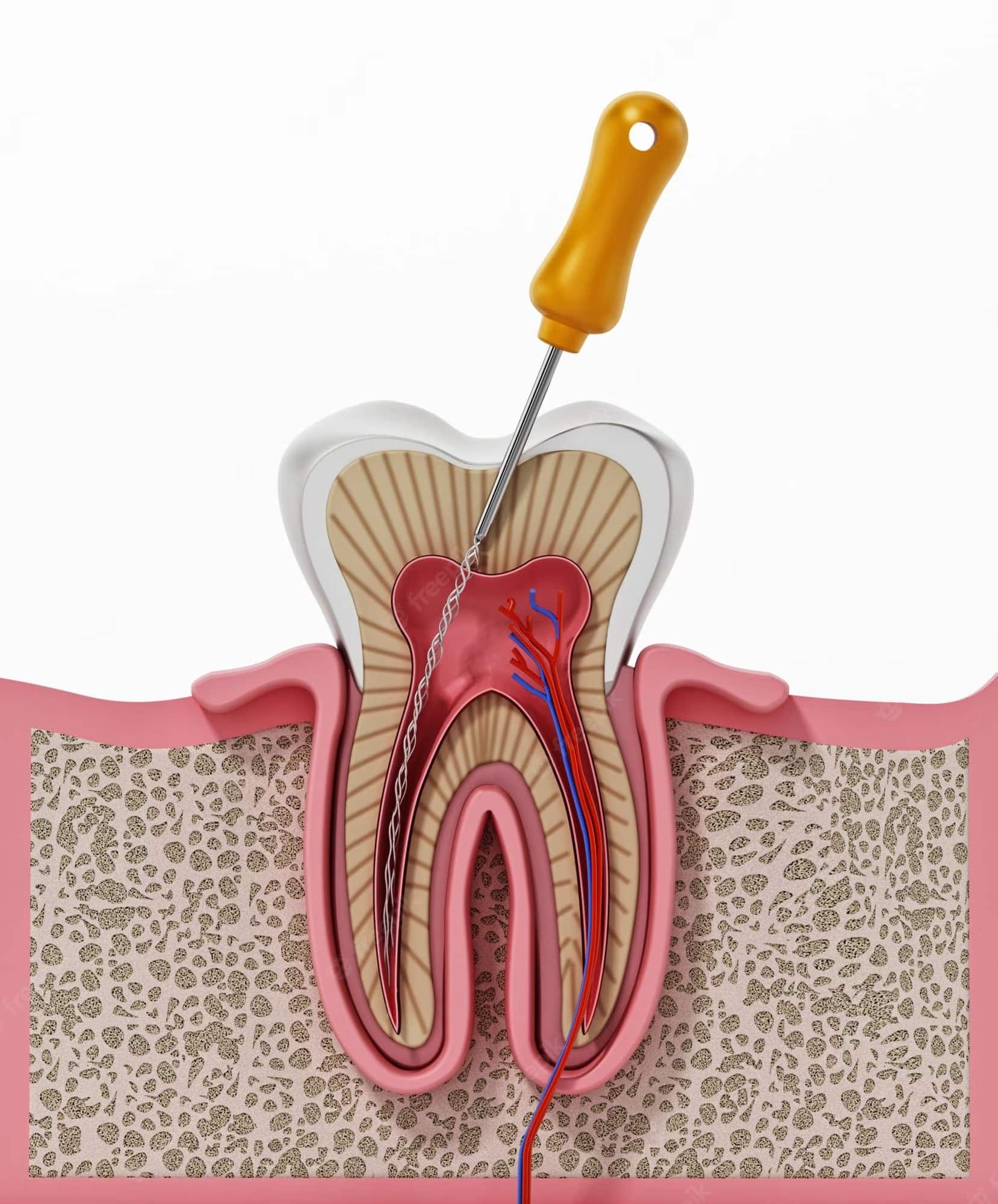 An illustration showcasing pain-free root canal treatment at Metro Decatur Dental Group PC.