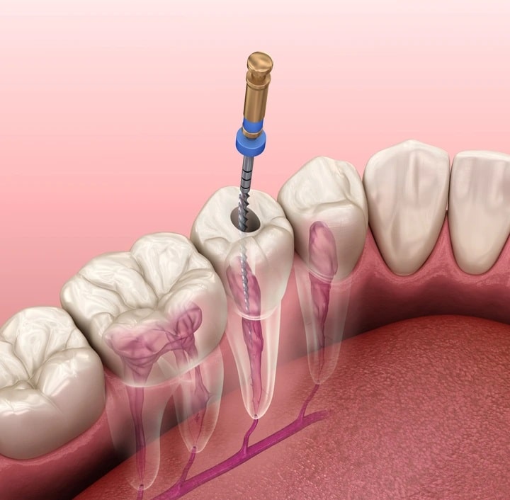 Illustration showing the steps of a root canal treatment at Metro Decatur Dental Group PC.