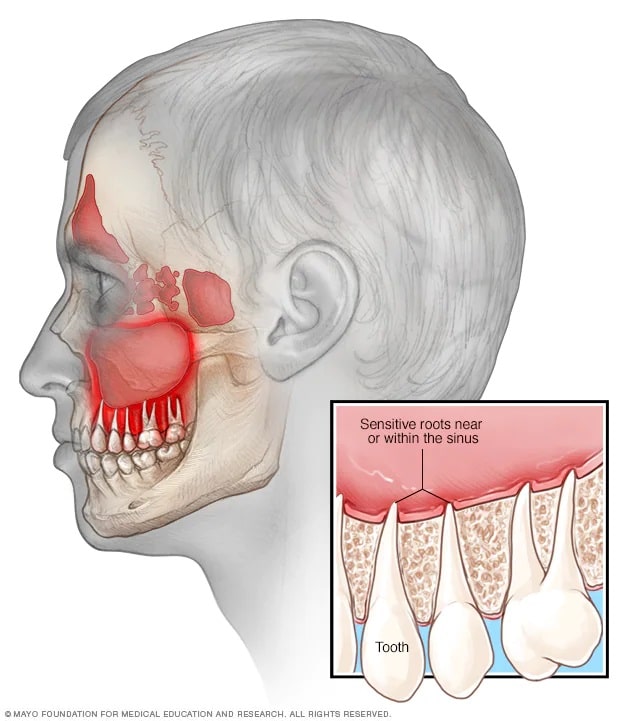 Illustration depicting the connection between sinus pain and toothaches.