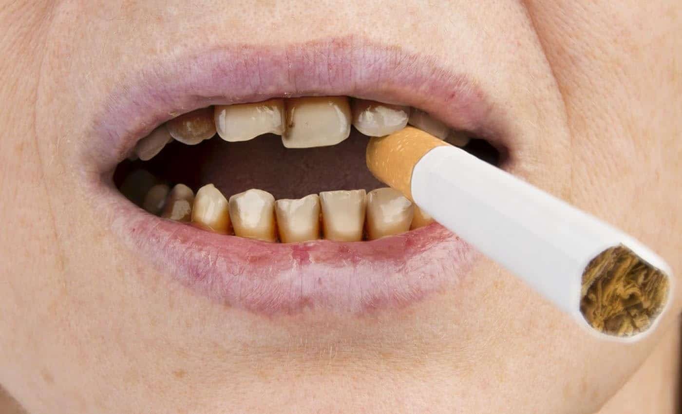 Illustration depicting the effects of smoking on oral health.
