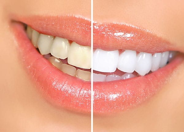 Comparison of Teeth Whitening Options: Drugstore vs. Professional