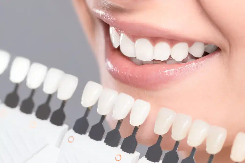 A picture showing various teeth whitening methods for a brighter smile.