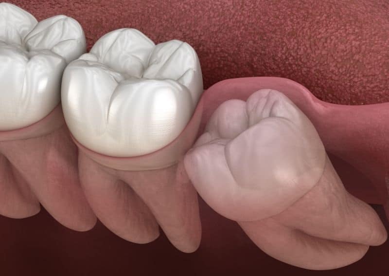 Illustration of wisdom teeth and their potential impact on oral health.