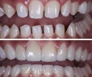 dental implants specialist decatur georgia