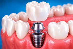 DeKalb County Dental Implant Specialists in Decatur