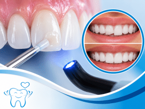 Dental Bonding