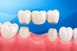 Dental Crowns & Bridges