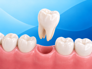 Tooth Extraction